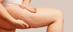 Woman holding her thigh, showing smooth legs in Wakefield, MA | Infinite Beauty Med Spa
