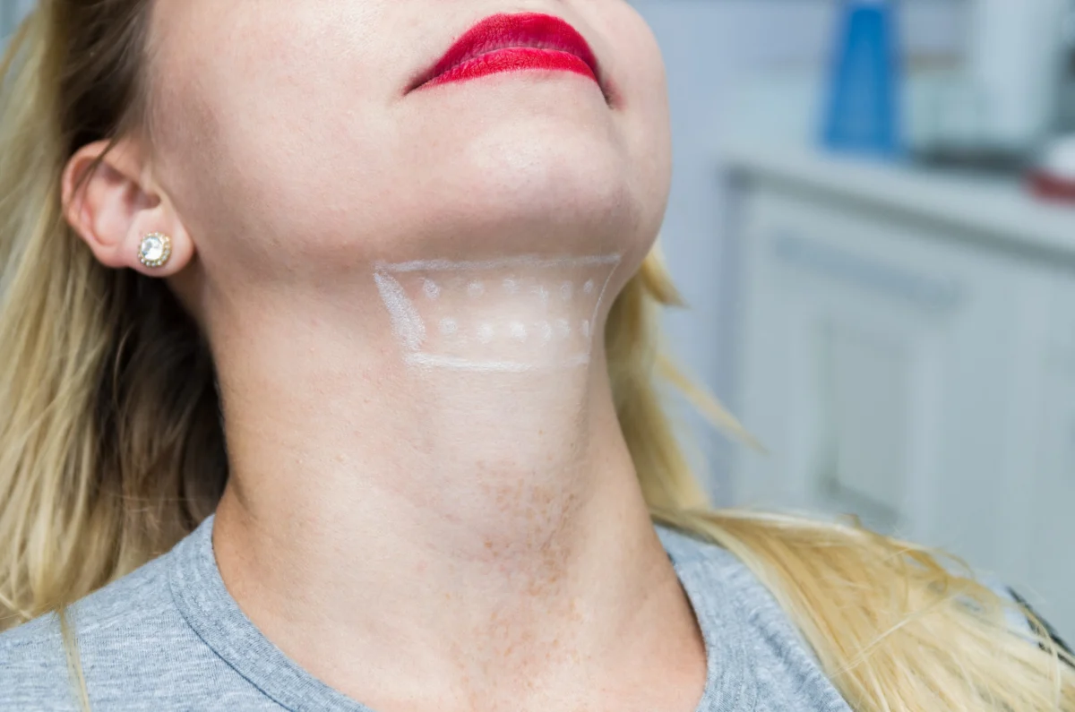 Woman showing under-chin area marked for Kybella treatment in Wakefield, MA | Infinite Beauty Med Spa