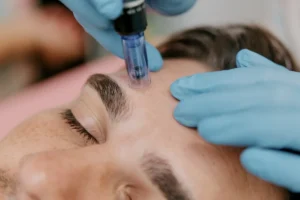 microneedling treatment wakefield ma